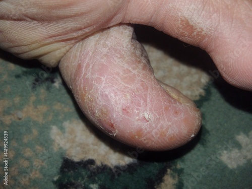 Close-Up of a Dry and Cracked Skin Condition on a Toe