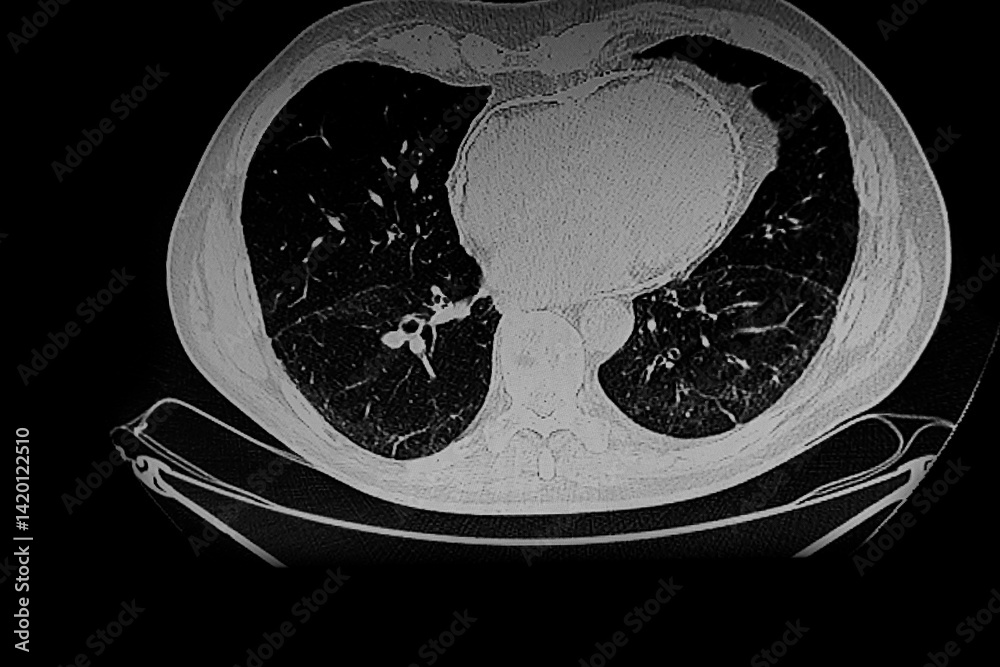 Medical themes: X- Ray image of calcific constrictive pericarditis