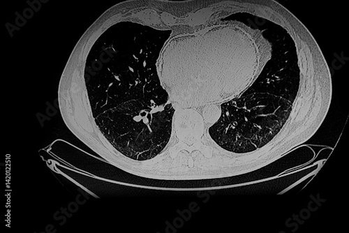 Obraz na płótnie Medical themes: X- Ray image of calcific constrictive pericarditis w salonie