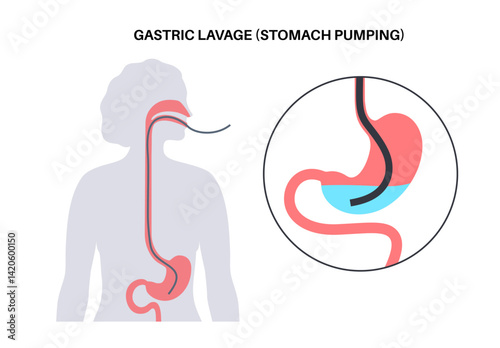 Stomach wash gastric lavage