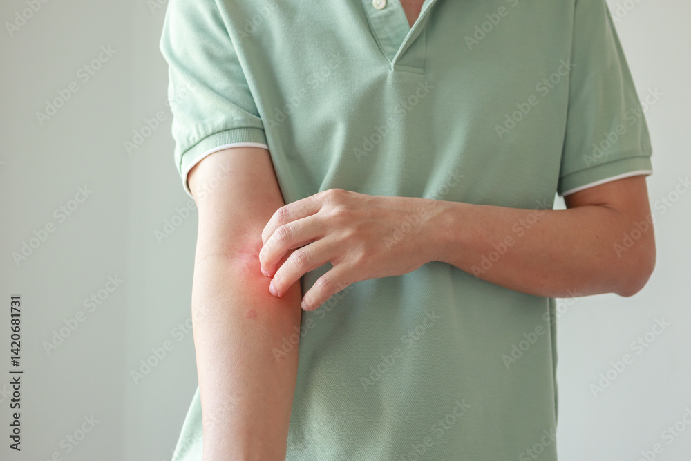 Young asian man itching and scratching on arm from allergic itchy dry skin eczema dermatitis insect bites Young asian man itching and scratching on arm from allergic itchy dry skin eczema dermatitis insect bites