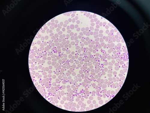 Fotografi This image shows a blood smear under a microscope, revealing an abnormally high number of platelets