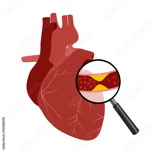 High Cholesterol Blood Pressure Tiny People Character Concept Vector Illustration, Suitable For Wallpaper, Banner, Background, Card, Book Illustration, And Web Landing Page