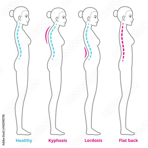Back posture problems medical diagram. Young woman with kyphosis, lordosis and flat back, healthy spine comparison. Infographic vector illustration.