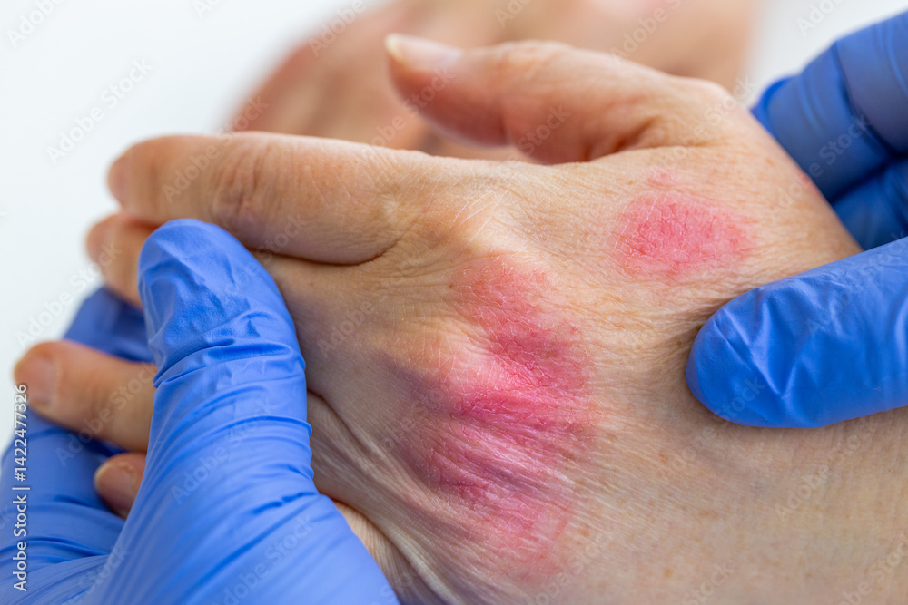 atopic dermatitis. red, itchy, woman hands. Cracked skin and allergic wounds on hands. Medical concept. close up. macro