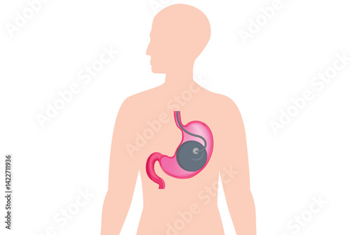 Medical illustration showing an intragastric balloon inside the human stomach, placed within a human body silhouette on a teal background. represent a weight loss procedure or bariatric treatment.