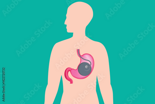 Medical illustration showing an intragastric balloon inside the human stomach, placed within a human body silhouette on a teal background. This diagram is used to represent a weight loss procedure.