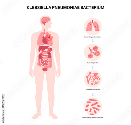 Klebsiella pneumoniae poster
