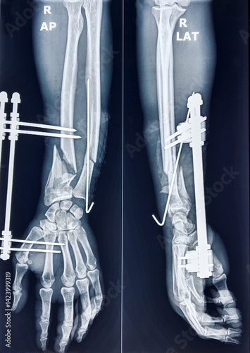 Quadro em tela X ray image of right forearm antero-posterior and lateral view showing fracture at the lower end of radius and ulna and fixation by plate & screw and k-wire (internal fixator)