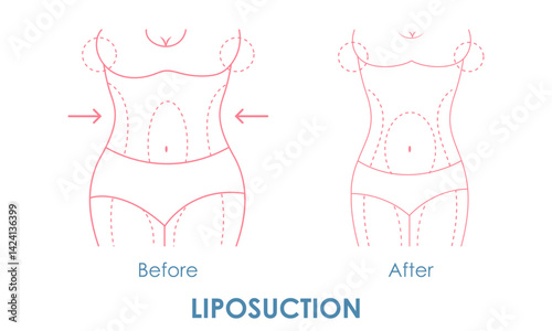 female body showing difference between before and after of Liposuction procedure. Weight loss and wellness concept