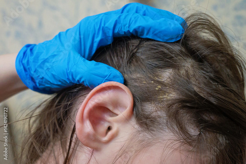 Children's dandruff. Seborrheic dermatitis. Scales on the scalp and hair.