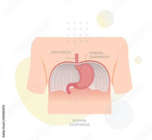 Normal Esophagus - Large Muscle between Abdomen and Diaphragm - Illustration