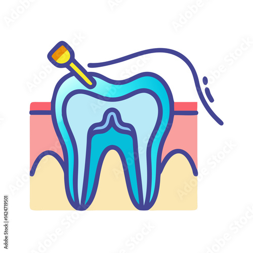 Root Canal Treatment: Dental Illustration of a Carious Tooth