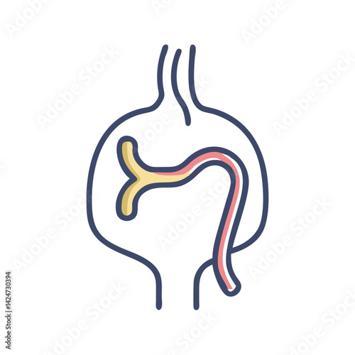 Endovascular Aneurysm Repair (EVAR) Procedure Graphic Illustration