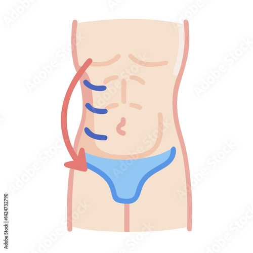 Liposuction Procedure Diagram Showing Fat Removal on Abdomen