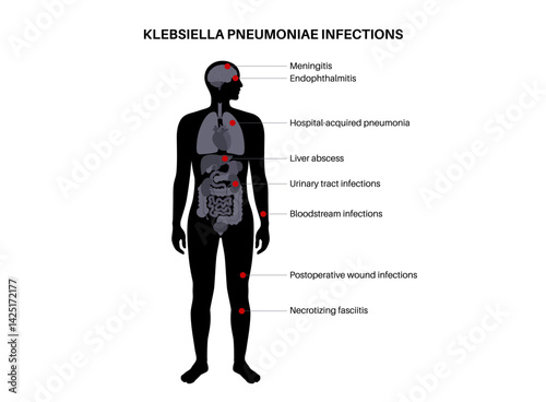 Klebsiella pneumoniae poster
