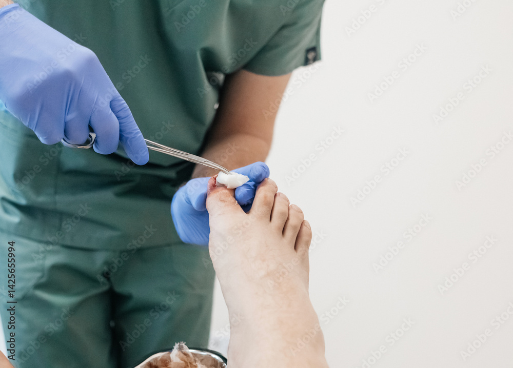 custom made wallpaper toronto digitalResection of the nail plate, removal of ingrown nail. Dressing after surgery on the toe. Surgical treatment of onychocryptosis, paronychia and purulent disease