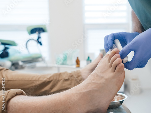 Wallpaper Mural Resection of the nail plate, removal of ingrown nail. Dressing after surgery on the toe. Surgical treatment of onychocryptosis, paronychia and purulent disease Torontodigital.ca