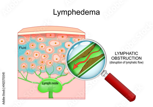 Lymphedema. Lymphatic vessel with disrupted lymph flow is visible through the magnifying glass.
