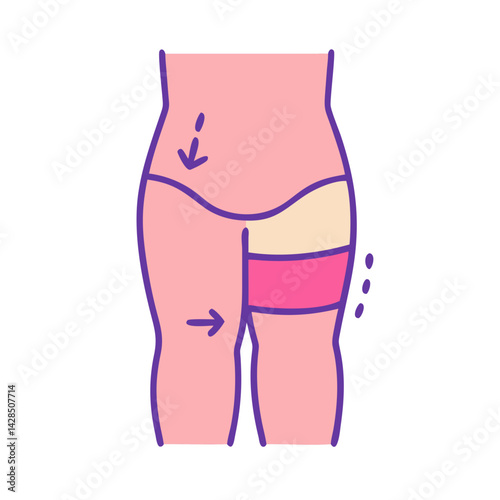 Liposuction procedure illustration on the hips and thighs