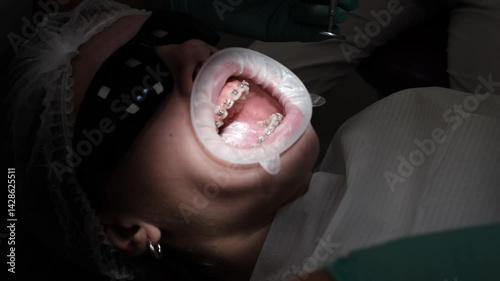Young woman with wide open mouth at the orthodontic clinic. Close-up: the doctor examines the teeth with the help of the mirror during brushing. The concept of an amazing smile