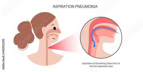 Aspiration pneumonia poster