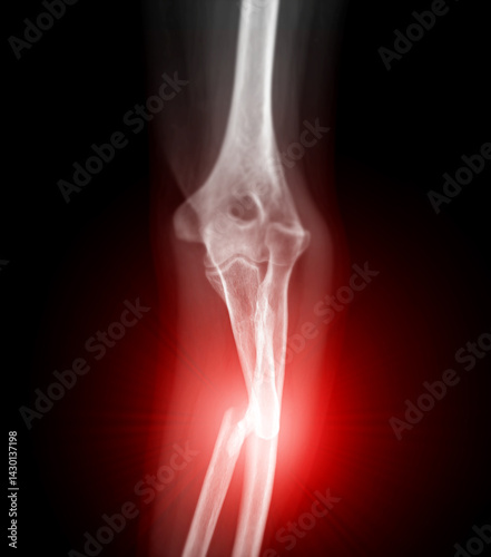 An X-ray image showing a fracture in the ulna bone of the elbow joint, with the injury site highlighted in red, indicating inflammation.