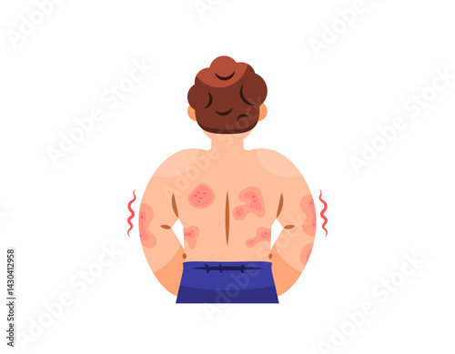 illustration of a man facing back. back full of red rashes. symptoms of skin disease, Atopic Dermatitis, eczema, Psoriasis, Fungal Infection. health problem. flat style character design. elements