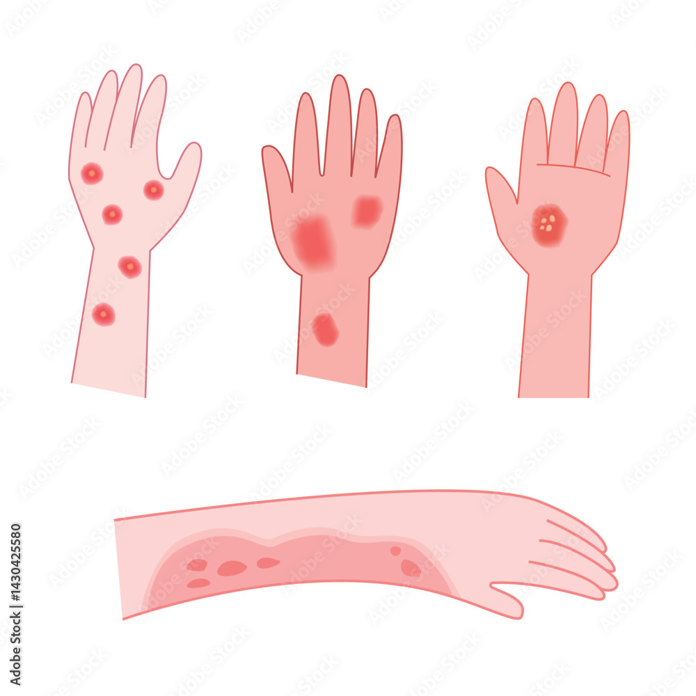 Fototapeta premium Red rash and itchy on hand cartoon for illustration and medical. Allergy concept