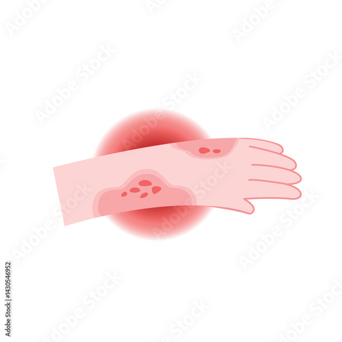 Red rash and itchy on hand cartoon for illustration and health care. Allergy and medical concept
