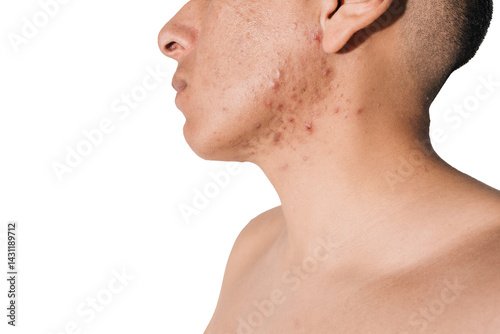 Cystic and hormonal acne on a man's face
