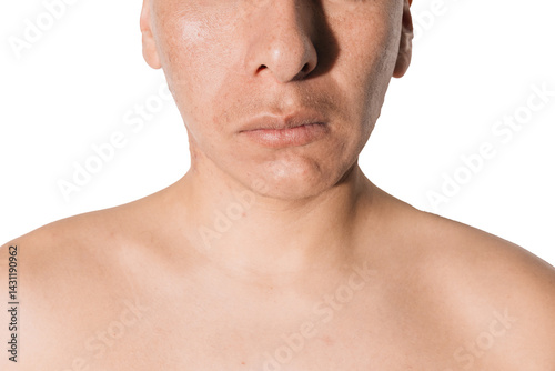 Facial asymmetry in a man, deviation of the mandible with a white background