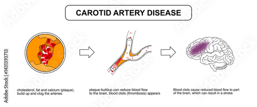Carotid artery disease. Blocked Arteries by cholesterol, fat, calcium plaque. risk of blood vessel blockage, risk of ischemic stroke, vector illustration of blood vessel problems