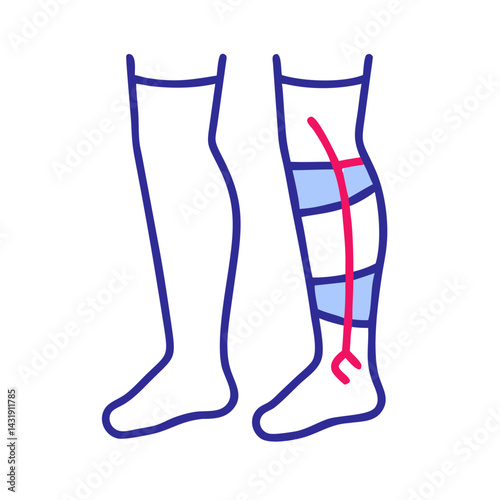 Leg Compression Therapy: Medical Illustration for Circulation Support