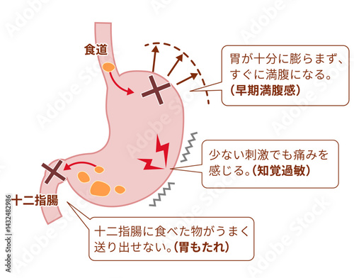 機能性ディスペプシア（FD）の症状と仕組みの説明図