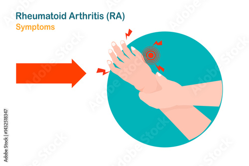 Illustration of a hand with rheumatoid arthritis. Flat medical illustration.