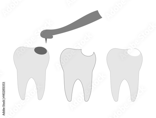 a set of three teeth with caries with a hole and a filling,