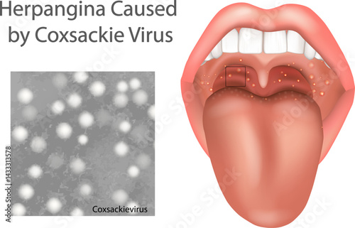 Herpangina Caused by Coxsackievirus. Medical Illustration of Coxsackievirus Infection in Throat and Mouth. Oral Herpangina Ulcers from Coxsackie Virus