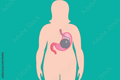 Female anatomy illustration with intragastric balloon for obesity treatment concept.