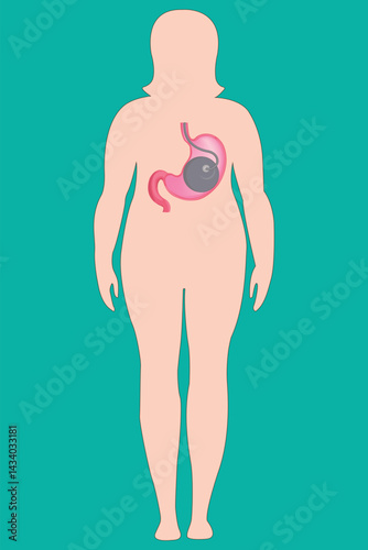 Digestive system treatment concept in obese female body with stomach balloon. eps 10
