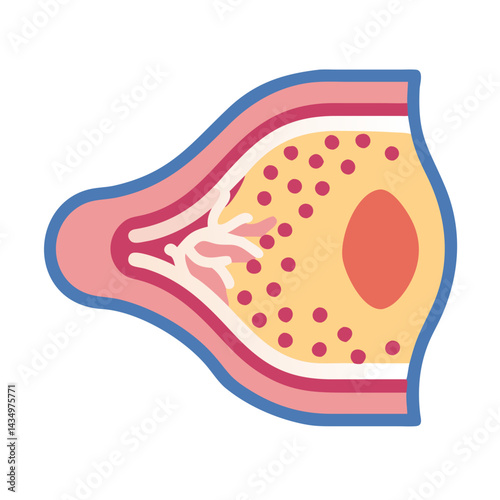Illustrated artery cross-section with plaque buildup and thrombosis risk