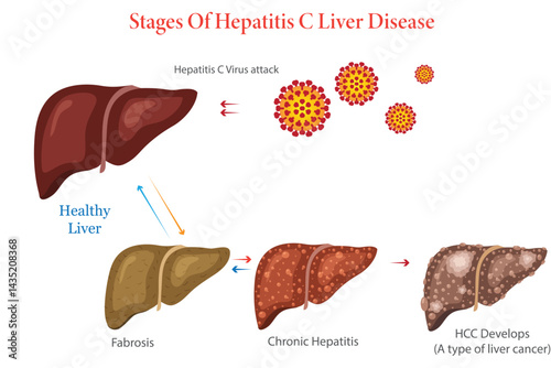 Diagram Illustration Showing Stages of Hepatitis C Liver Disease Progression