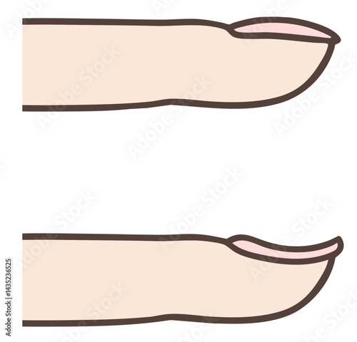 正常な爪とスプーン爪の比較イラスト