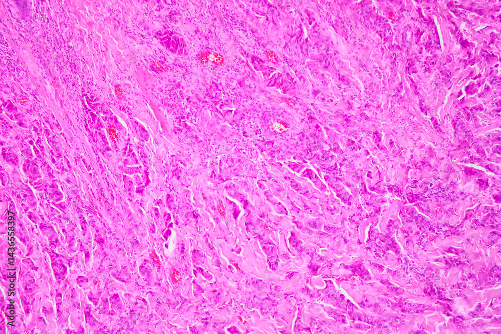 Medical themes: Microscopic image of breast cancer