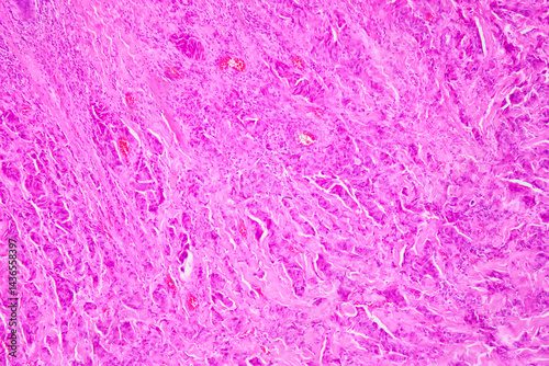 Obraz na płótnie Medical themes: Microscopic image of breast cancer w salonie