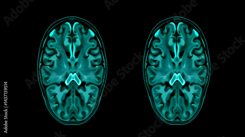 Computed medical tomography MRI upscaled scan of healthy young female head. Front view. Optically retimed for smooth motion. Green on black background.