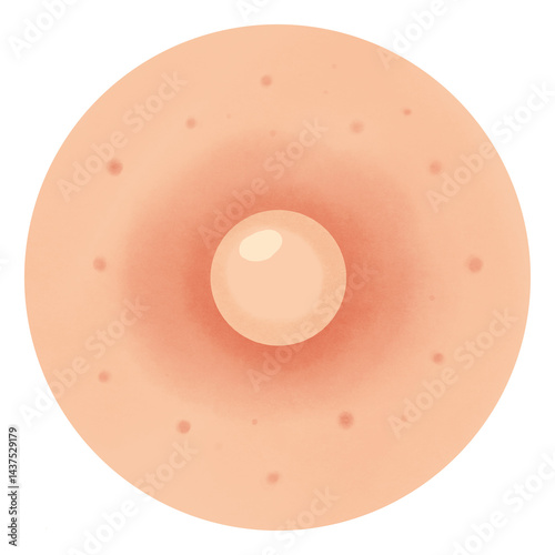 Types of Acne illustration 