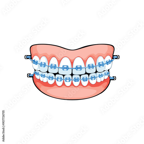 Teeth with braces and without. Arch model of braces. Orthodontic dental treatment. Proper alignment of teeth. Bright white teeth with a smile and braces.