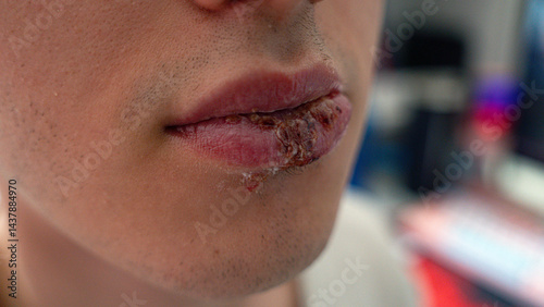 Tableau sur toile Detailed close-up of a young man's lips affected by herpes simplex infection, sh