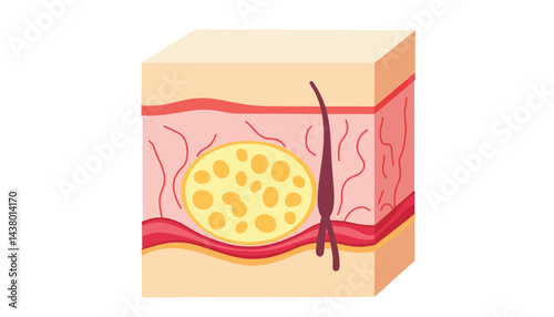 Cross-sectional illustration of human skin layers highlighting fat, education